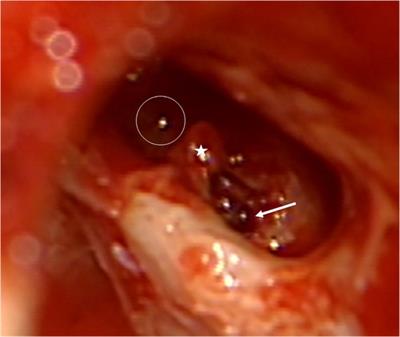 A new device for the removal of cochlear schwannoma: A temporal bone study